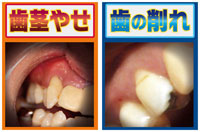 歯茎やせ・歯の削れ