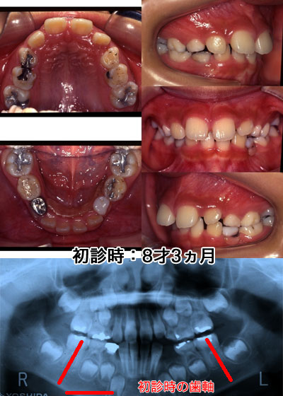 初診時：8才3ヵ月