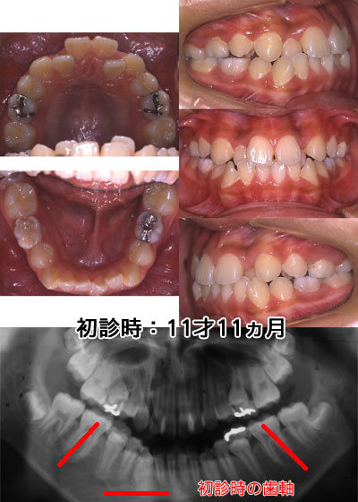 初診時：11才11ヵ月