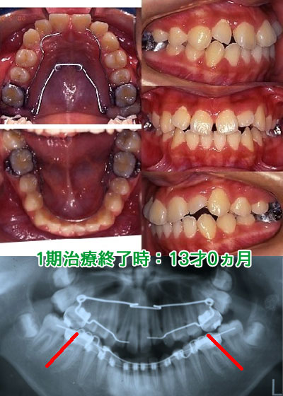 1期治療終了時：13才0ヵ月