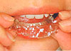 定期的に新しいマウスピース型矯正歯科装置（クリアアライナー）を順次使用