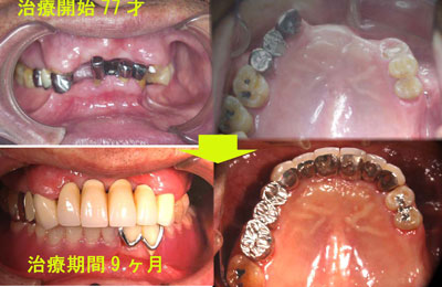 歯槽膿漏、補綴によるTMJ症改善