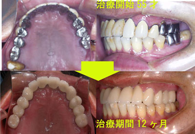 膿 漏 治療 歯槽