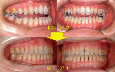骨格性Ⅲ級開咬症例 オーバージェット-3㎜ オーバーバイト-3㎜