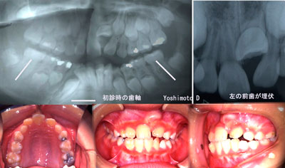 初診時年齢：９才３ヶ月