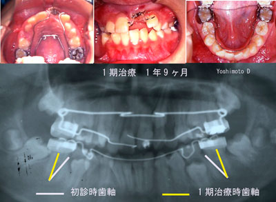 1期治療 １年９ヶ月