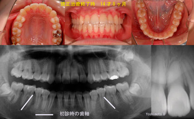 矯正終了時 14才8ヶ月