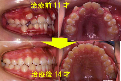 施術例：子供