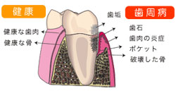 健康な歯と歯周病