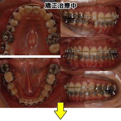 矯正治療中