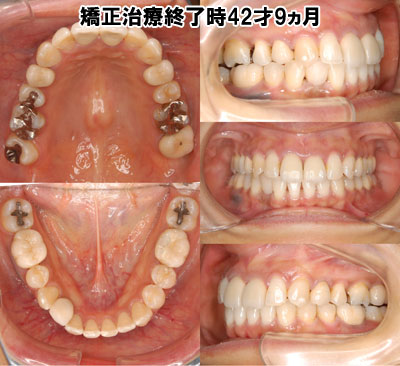 矯正治療終了時42才9ヵ月
